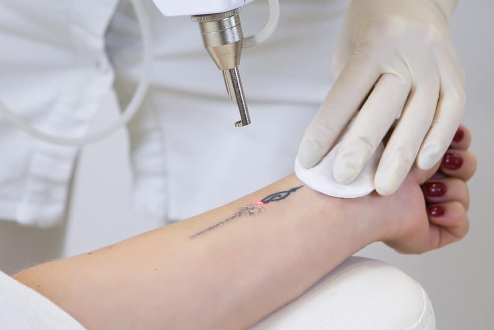 A person receives laser tattoo removal at a studio often frequented by top tattoo artists in Nassau County, NY. A gloved hand holds a device emitting a laser and presses a white pad on the skin. The tattoo appears partially faded, while their dark red nail polish gleams under the light.