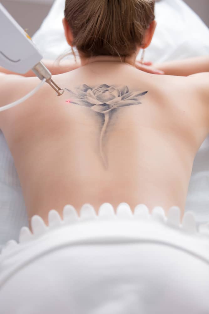 Laser Tattoo Removal  Lenzie Clinic  Laser Treatments Wellington